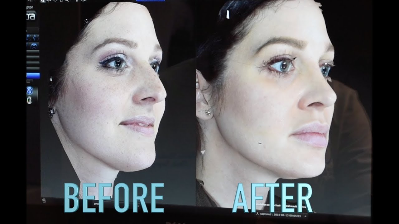 Rhinoplasty | 3D Imaging | Khoobehi & Associates