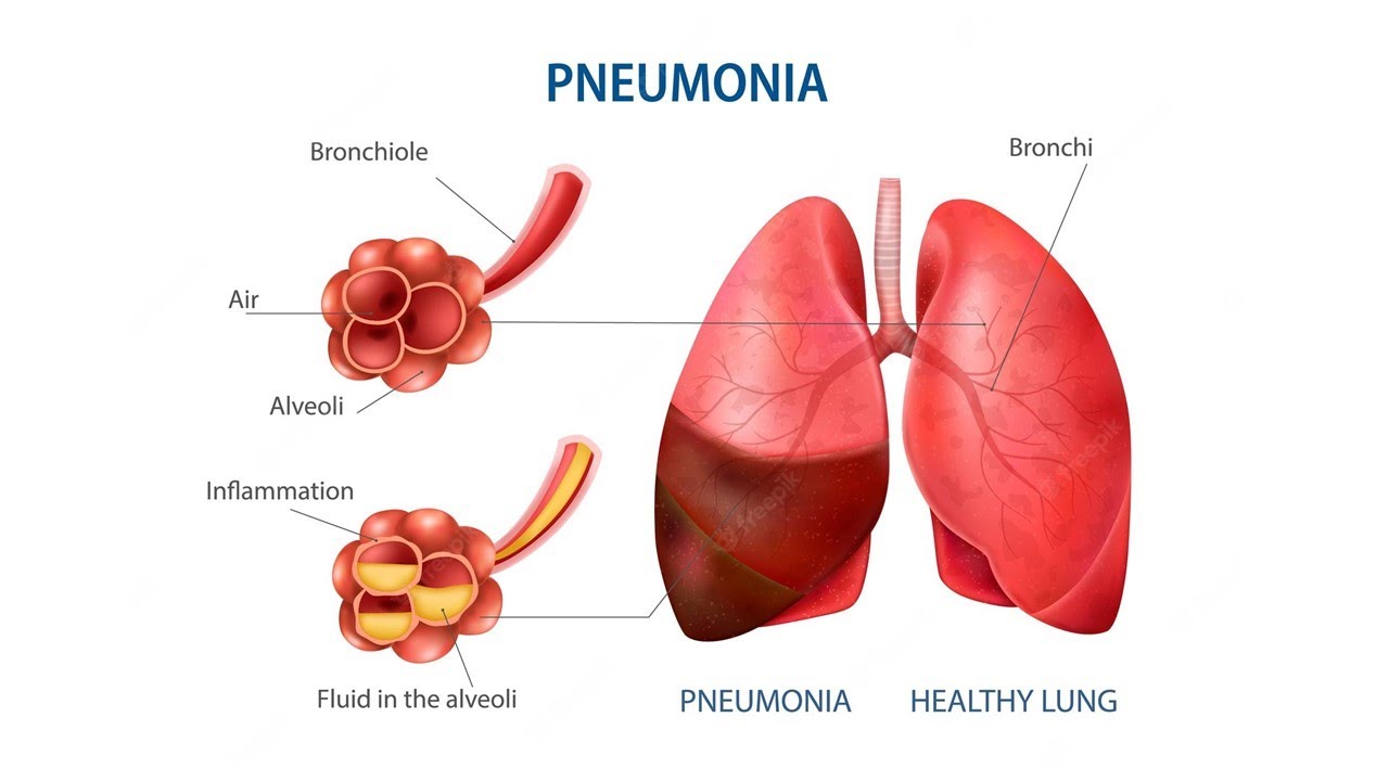 Pneumonia  Respiratory Tract Infection therapeutics علاجيات  الالتهاب الرئوى