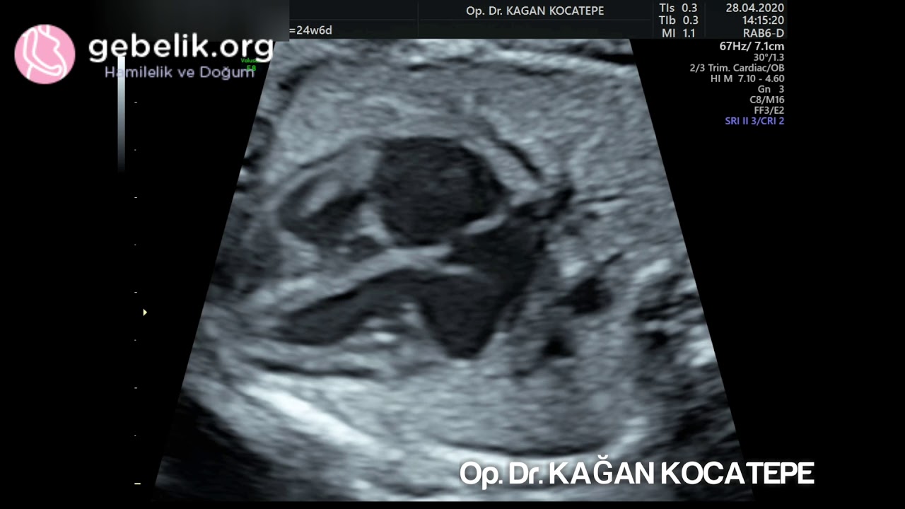 ULTRASONDA FETAL KALP YAPISI VE GÖRÜNÜMÜ NASILDIR? KALBİN DÖRT ODACIK GÖRÜNTÜSÜ VE KALP KAPAKLARI