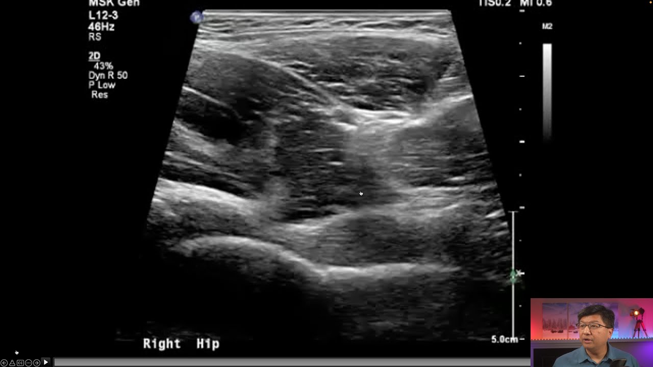 Ultrasound Guided Joint Injection - How I do it