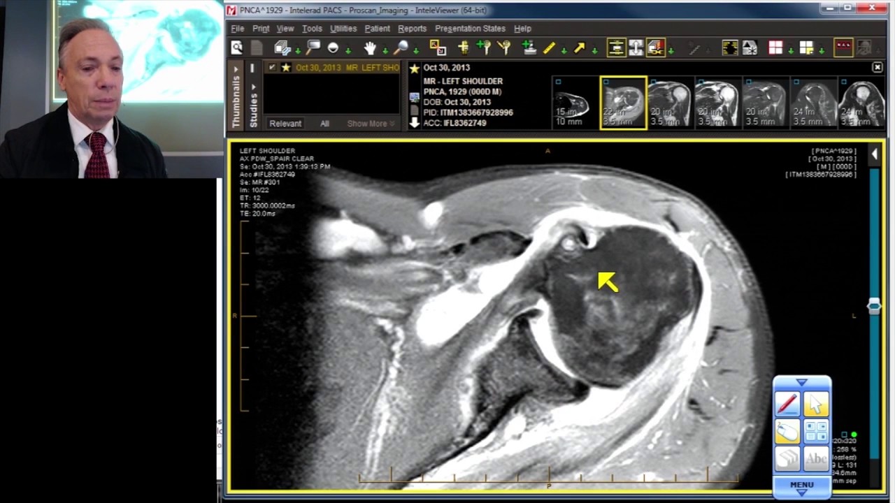 MRI Case Review: Shoulder Deep Dive