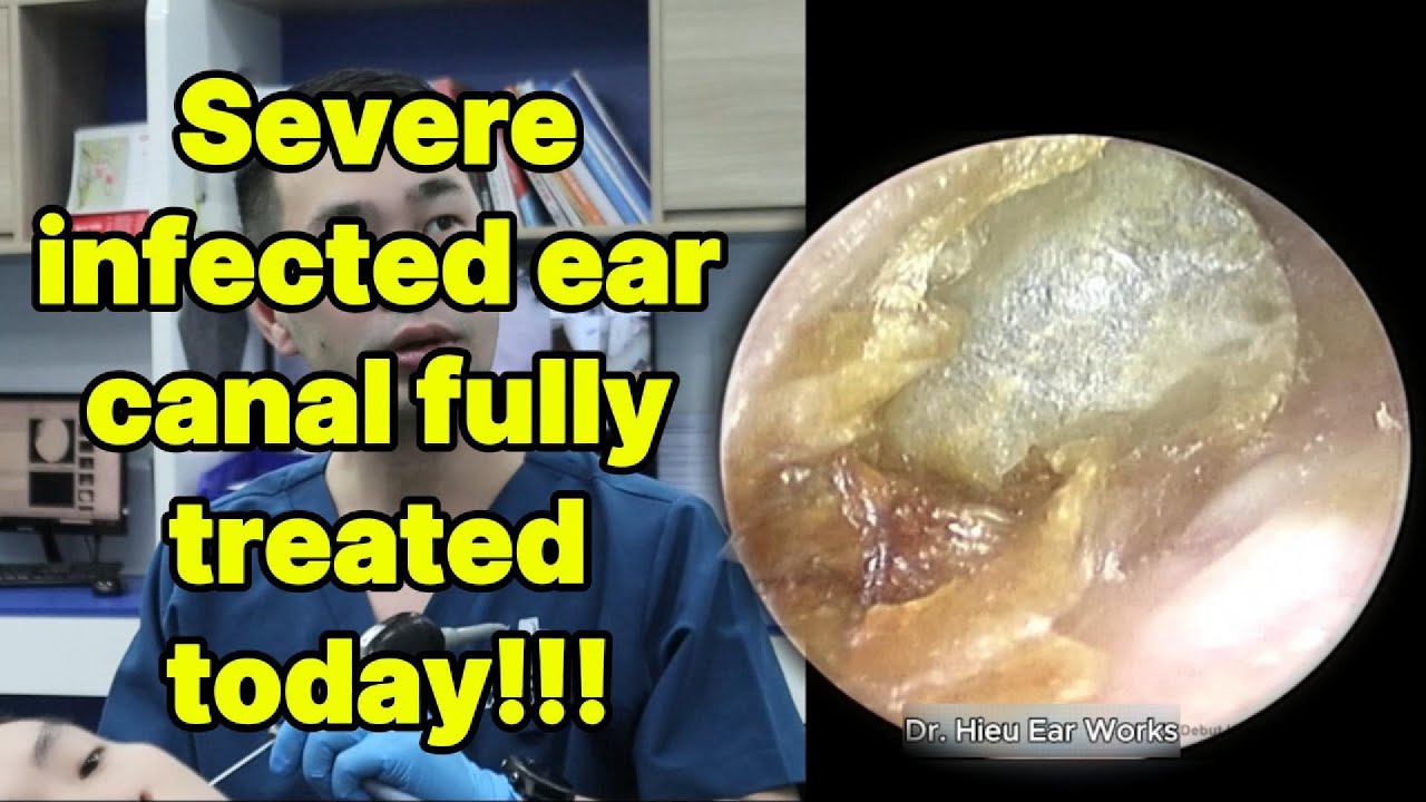 Severe infected ear canal fully treated today | ear cleaning | ASMR earwax | soothing |relax|
