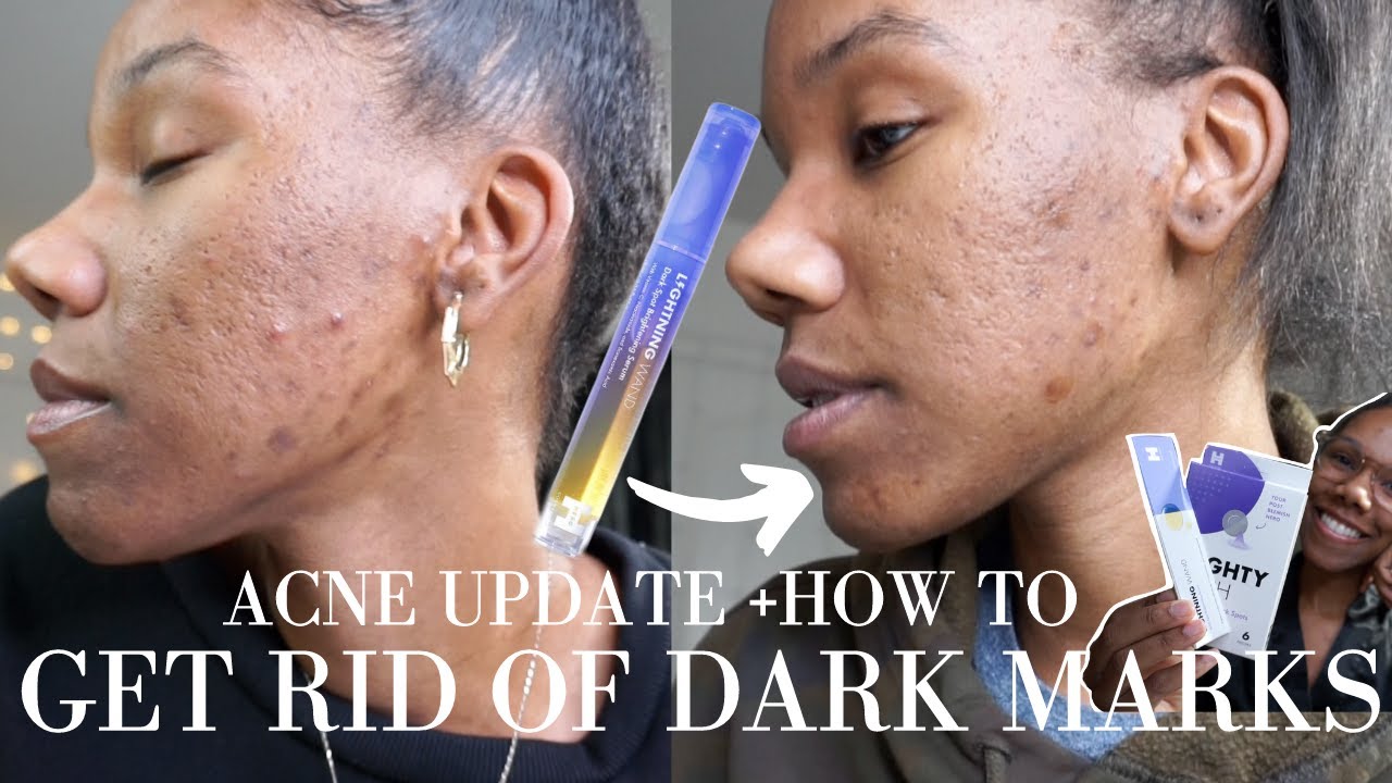 How to get rid of dark marks + acne scars | Acne Update ft. Hero Cosmetics