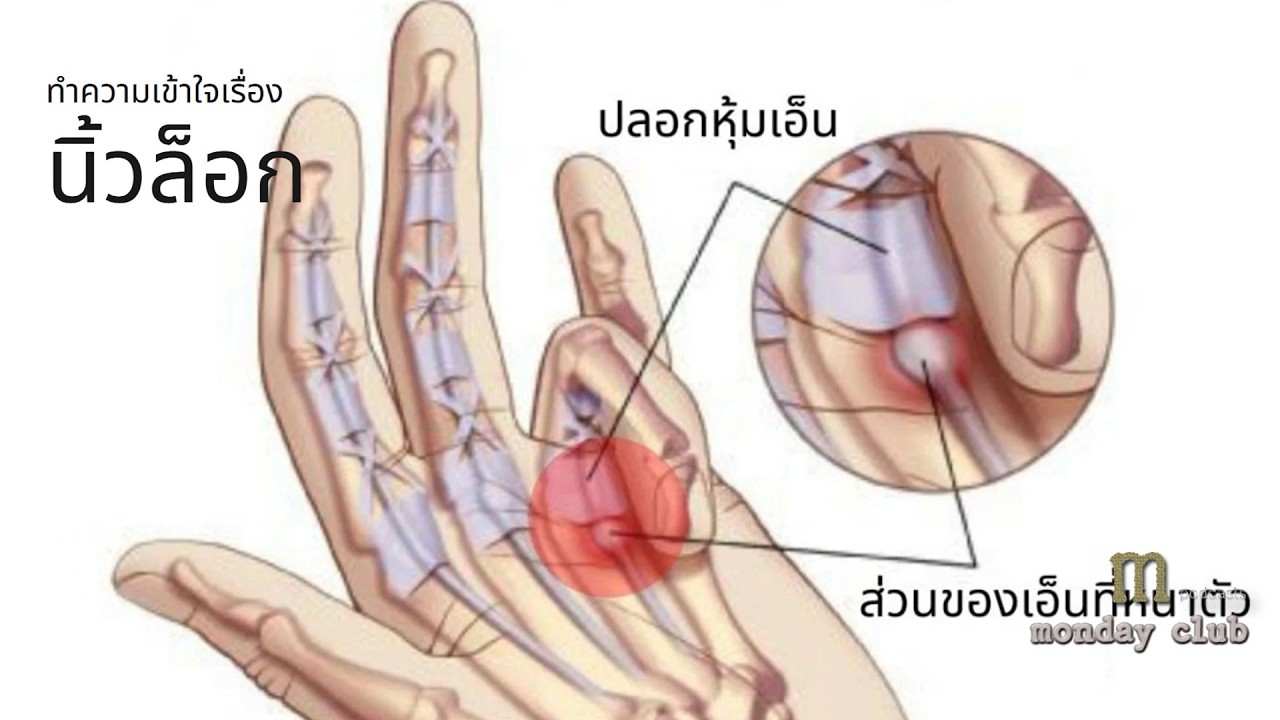 นิ้วล็อก สาเหตุ อาการ วิธีรักษาและการป้องกันอย่างครบถ้วน
