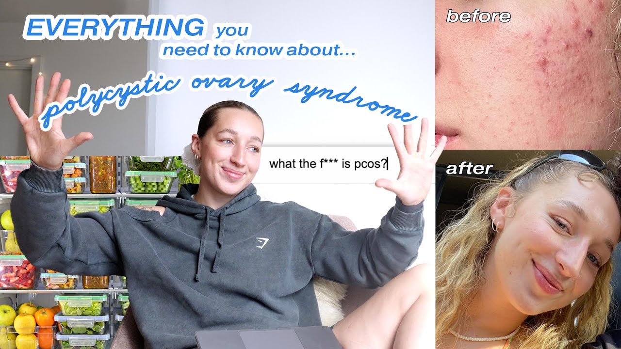 how I healed my PCOS (no more acne, managing my diet & exercise)