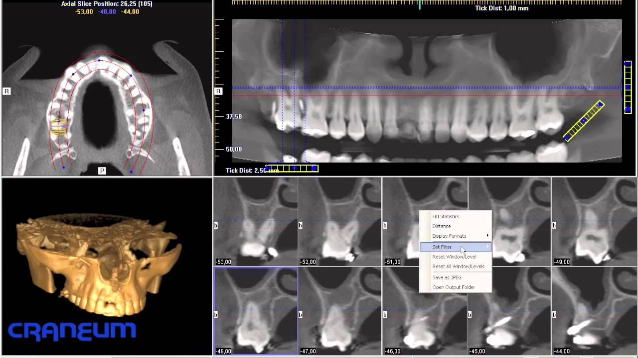 Tutorial CRANEUM i-Cat Vision - parte1 - Tomografia Computadorizada Volumetrica ( Cone Beam )