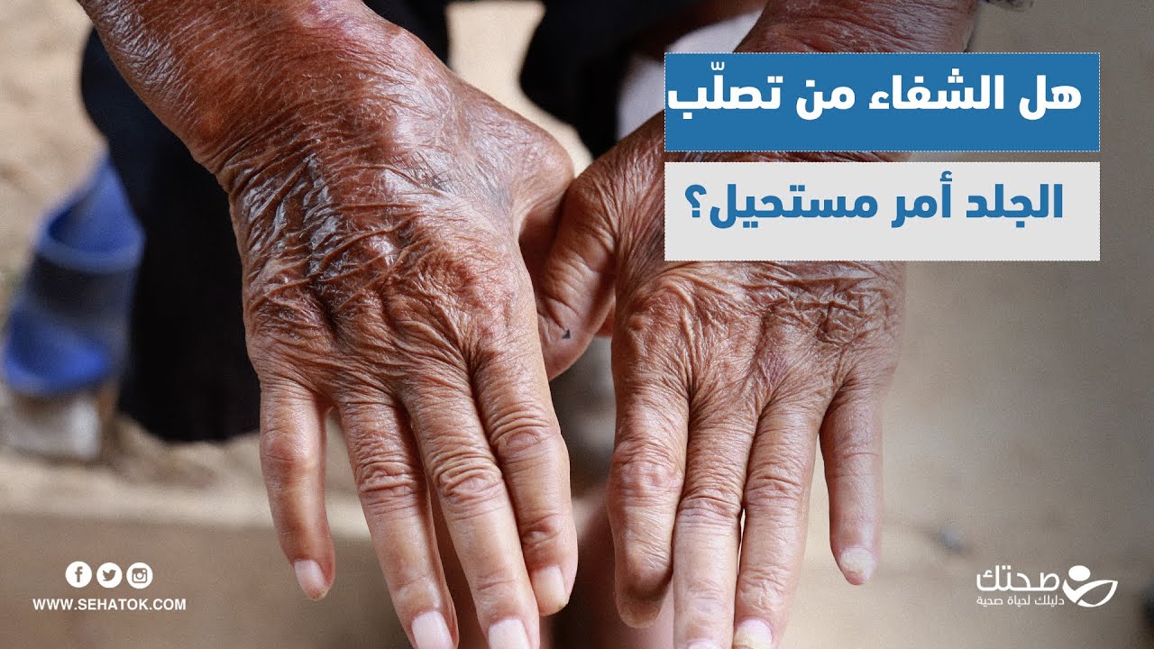 برنامج صحتك والحياة | هل يمكن الشفاء من تصلب الجلد ؟ اكتشف المزيد عن هذا المرض النادر والخطير !
