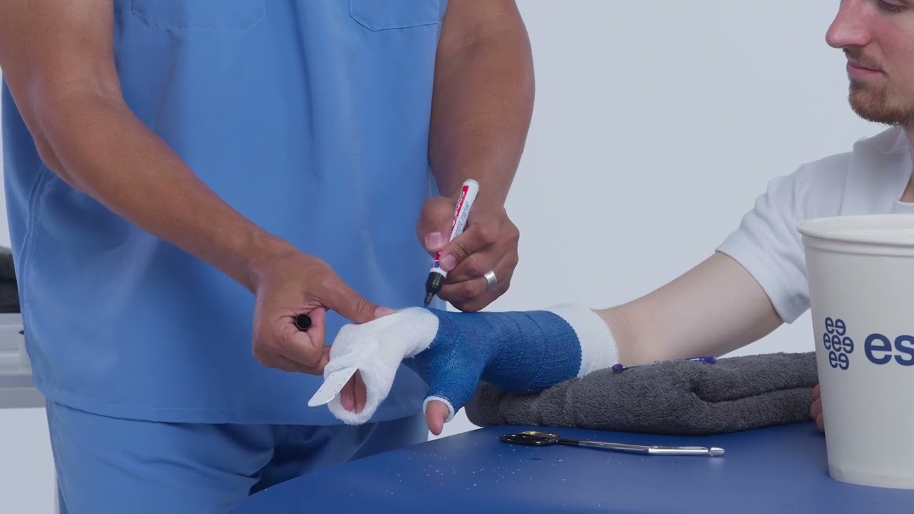 Thumb Spica Functional Cast Tutorial by Delta-Cast®
