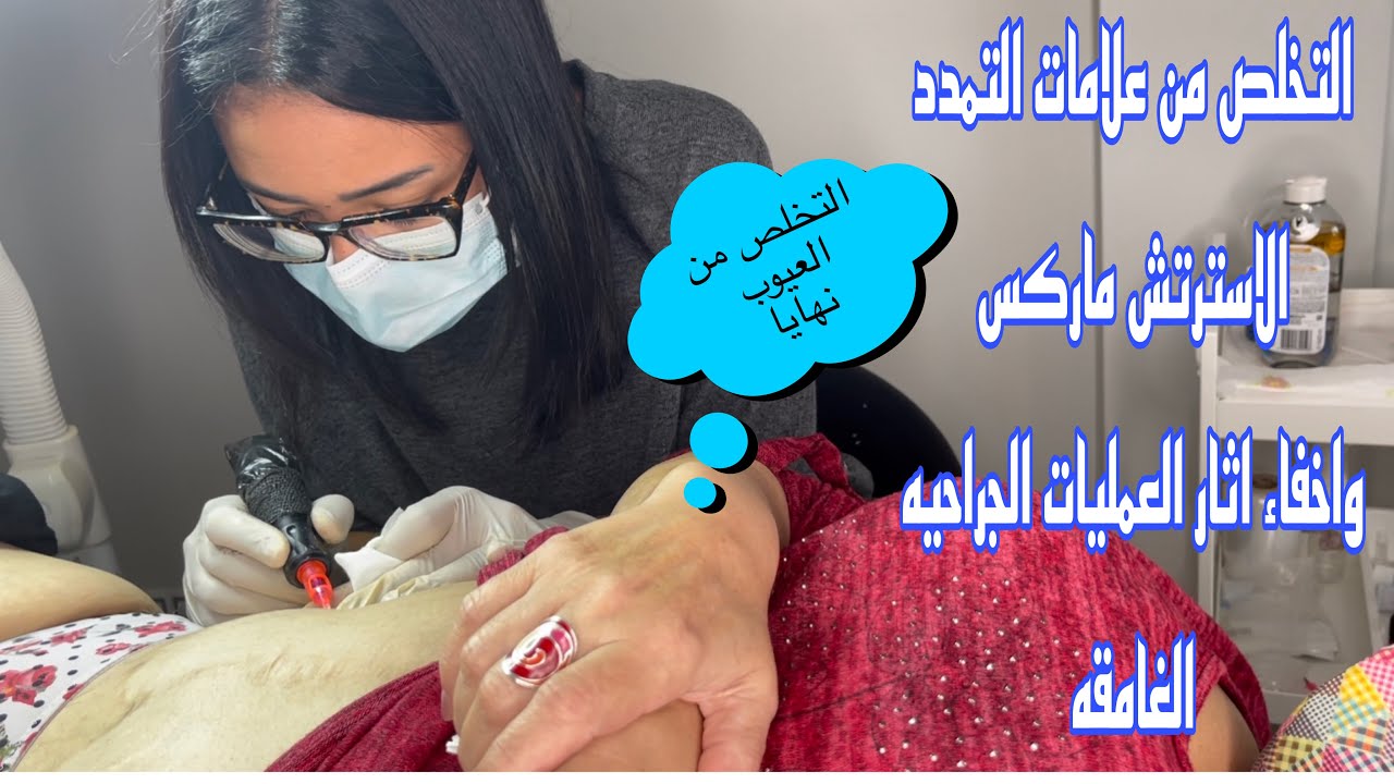جلسه  ميكروبجمنتيشين مع العميله لاخفاء علامات التمدد واثار عمليات الجراحيه الغامقه 😯