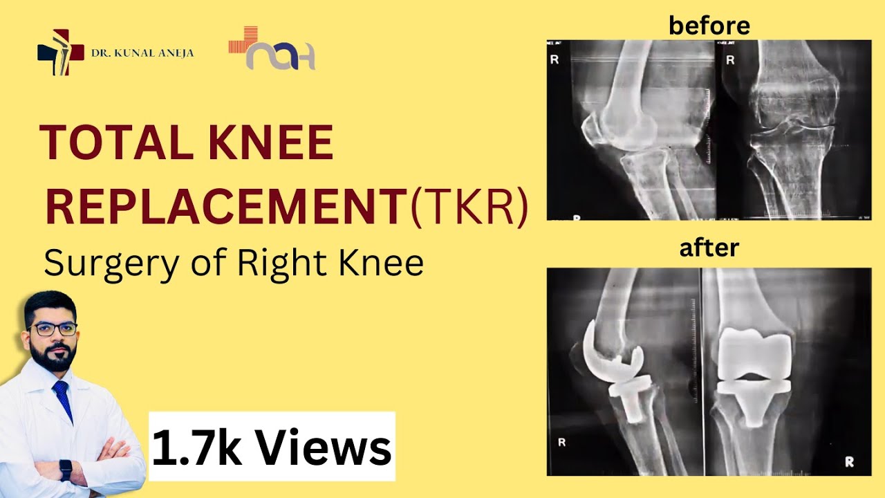 Patient Successful Journey | Right Total Knee Replacement (TKR) Surgery | Dr. Kunal Aneja | Delhi