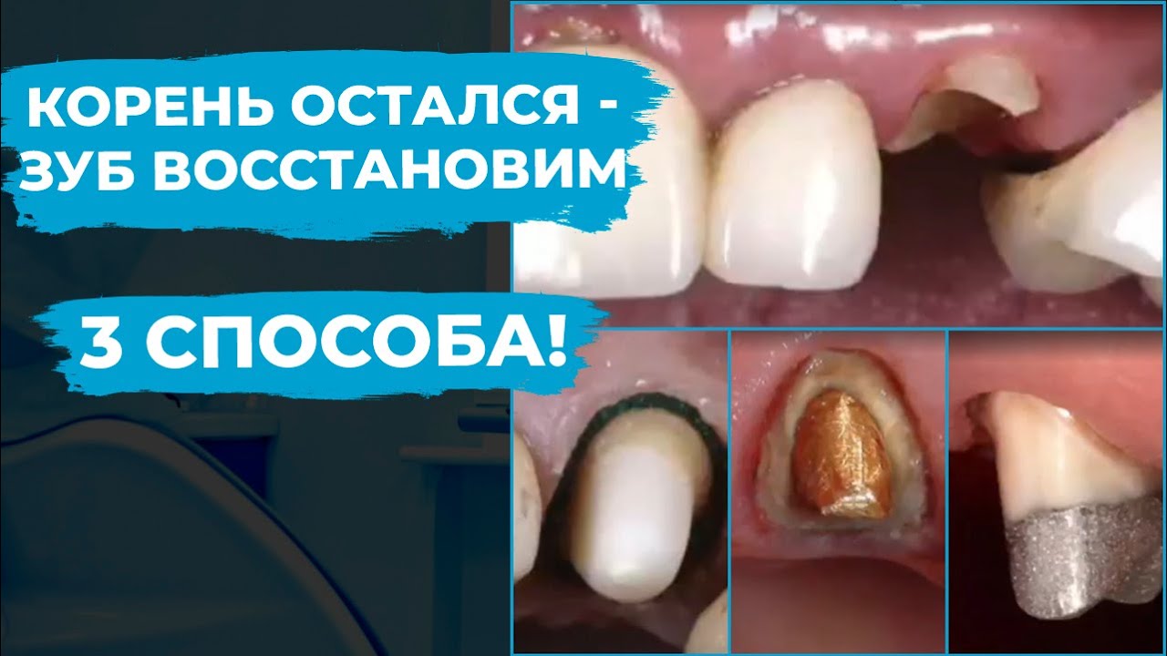 Остался корень зуба. 3 метода восстановления!