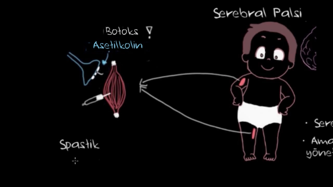 Serebral Palsi (Beyin Felci) Nasıl Y&ouml;netilir? (Sağlık ve Tıp) (Psikoloji)