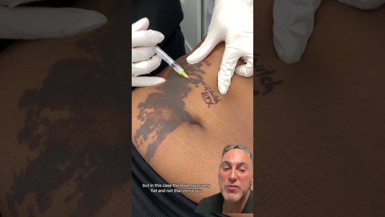 Test Spots with Various Lasers for Birthmark Removal