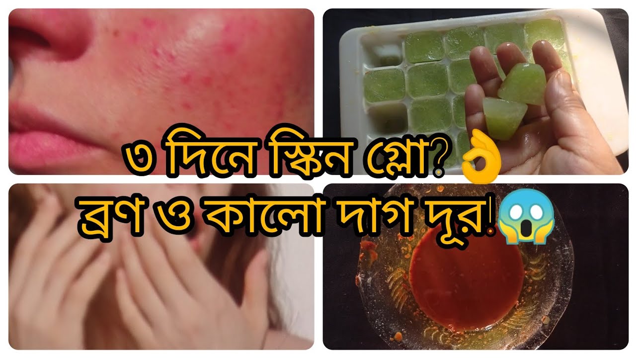 মাত্র ৩ দিনে ব্রণ ও কালো দাগ দূর করার সহজ উপায়!|| How to remove pimple mark/Acne mark In just 3 days