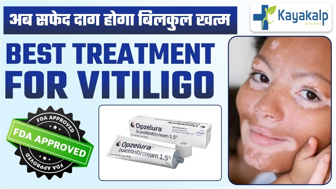 क्या Opzelura Cream सच में सफेद दाग ठीक करती है? | FDA Approved New Vitiligo Cream | Kayakalp global