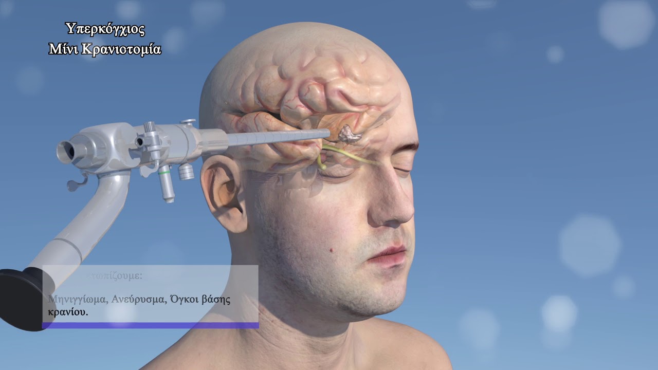3D Medical animation - Minimally Invasive Neurosurgery
