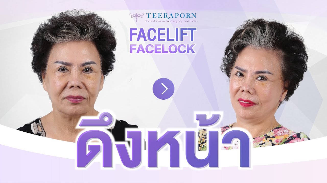 รีวิวดึงหน้า Facelift ตกใจ!!!ดึงหน้าเสร็จ 2 นาที ลงมารีวิวกันสดๆเลยค่ะ ธีรพรคลีนิก หมอชลธิศ