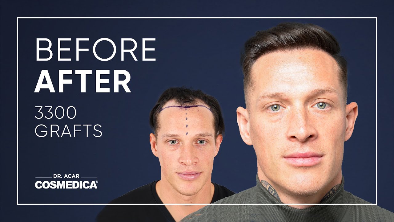 Hair Transplant Result of Denis Toplak - Cosmedica - Dr. Acar