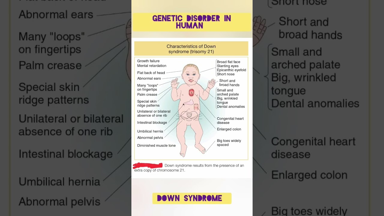 Down Syndrome | Trisomy 21 | Genetic Disorder in Human