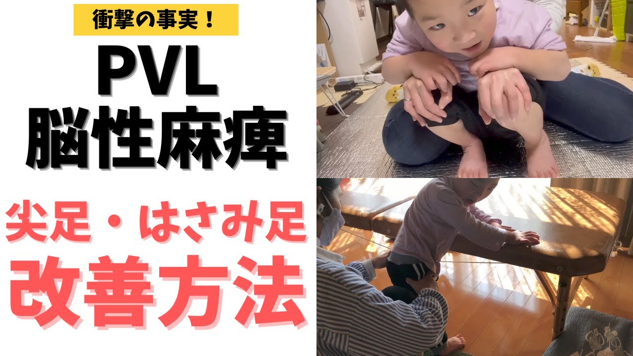 【衝撃の事実】脳室周囲白質軟化症や脳性麻痺の尖足・はさみ足の改善方法