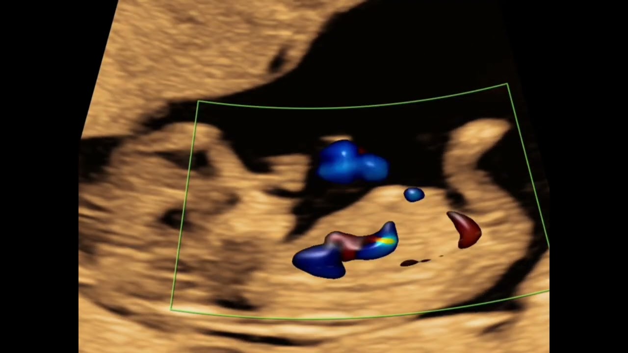 Embarazo de 11 semanas y 3 días. Circulación fetal. Voluson Swift.