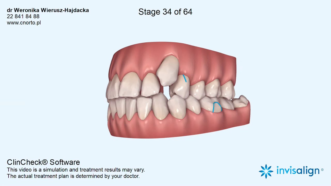 Aparat ortodontyczny Invisalign - wizualizacja leczenia dr Weronika Wierusz-Hajdacka