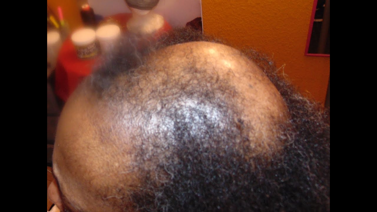 Crochet Cuban Locs On Hair Loss & Alopecia! Watch This Transformation!