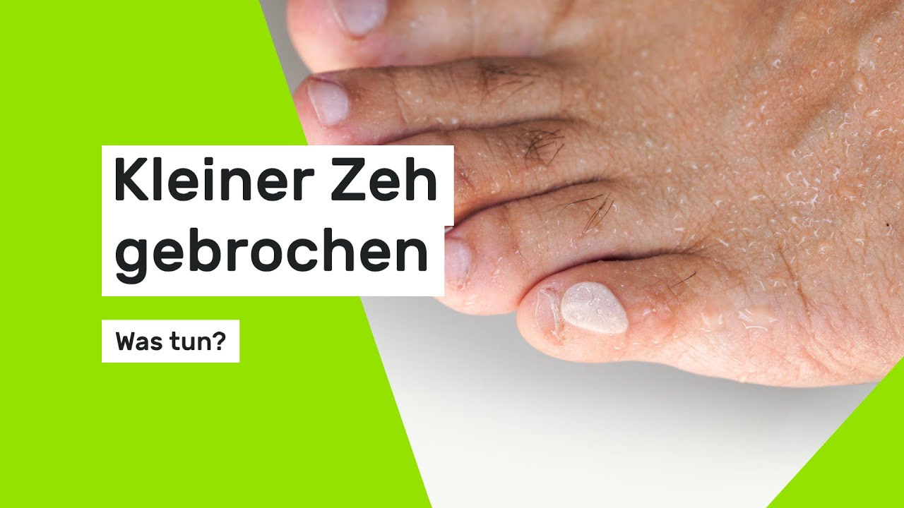 Kleiner Zeh gebrochen - was tun?