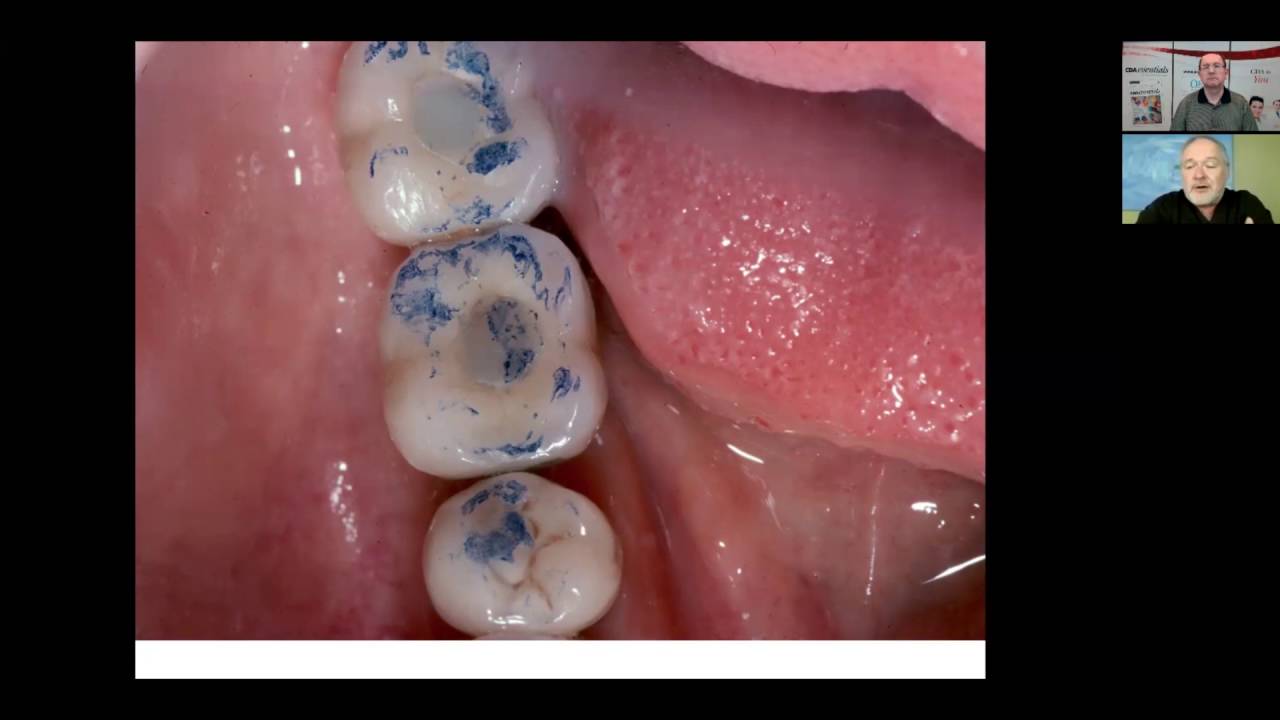 Single Impants and Occlusion
