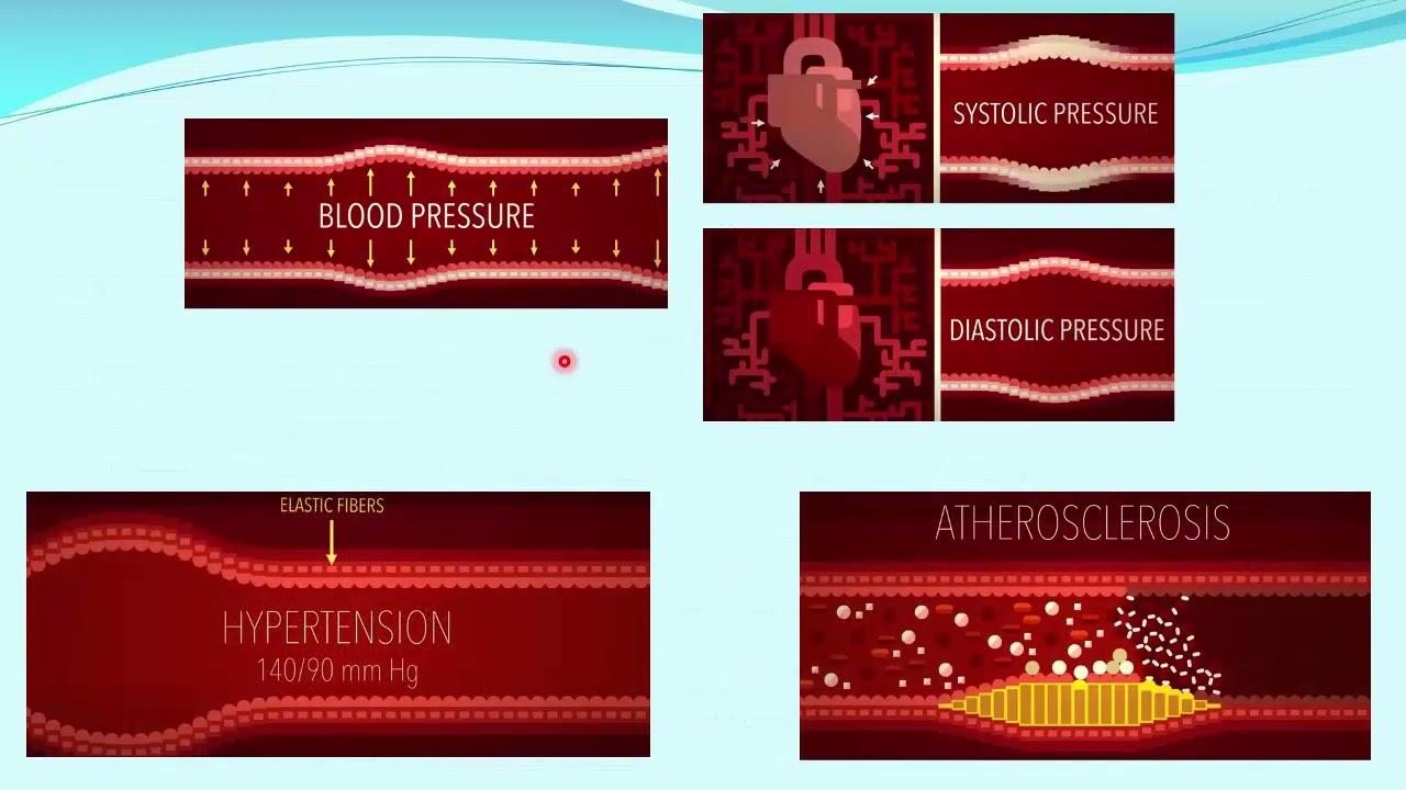 L1 Intensive care theories