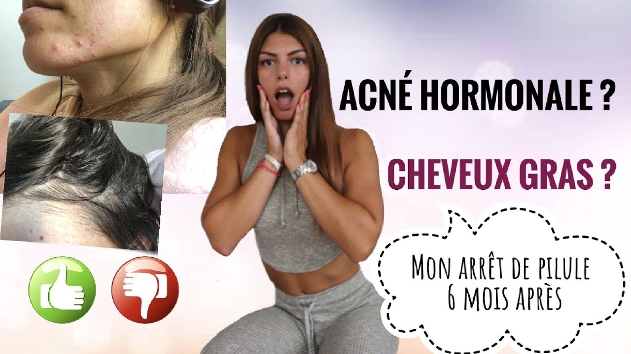 Arrêt de la pilule : Effets secondaires ? Acné, déprime, cheveux gras ?