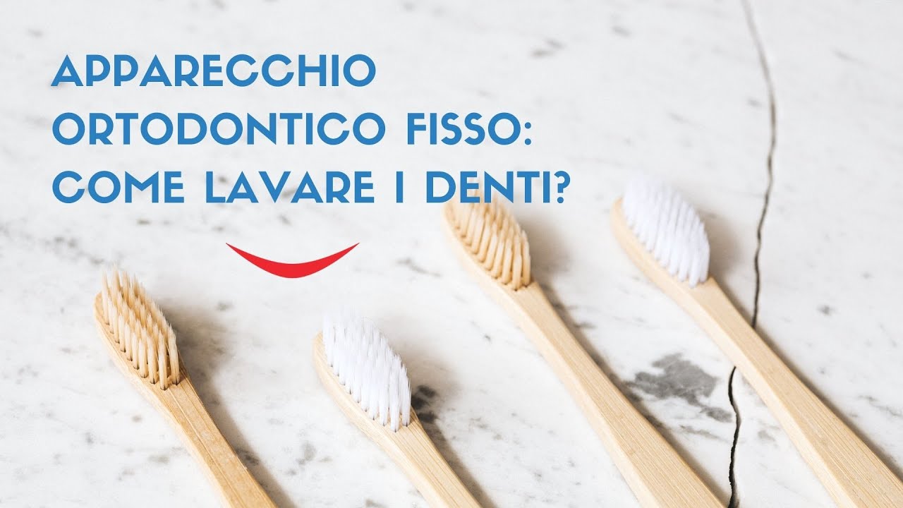Apparecchio ortodontico fisso: come lavare i denti?