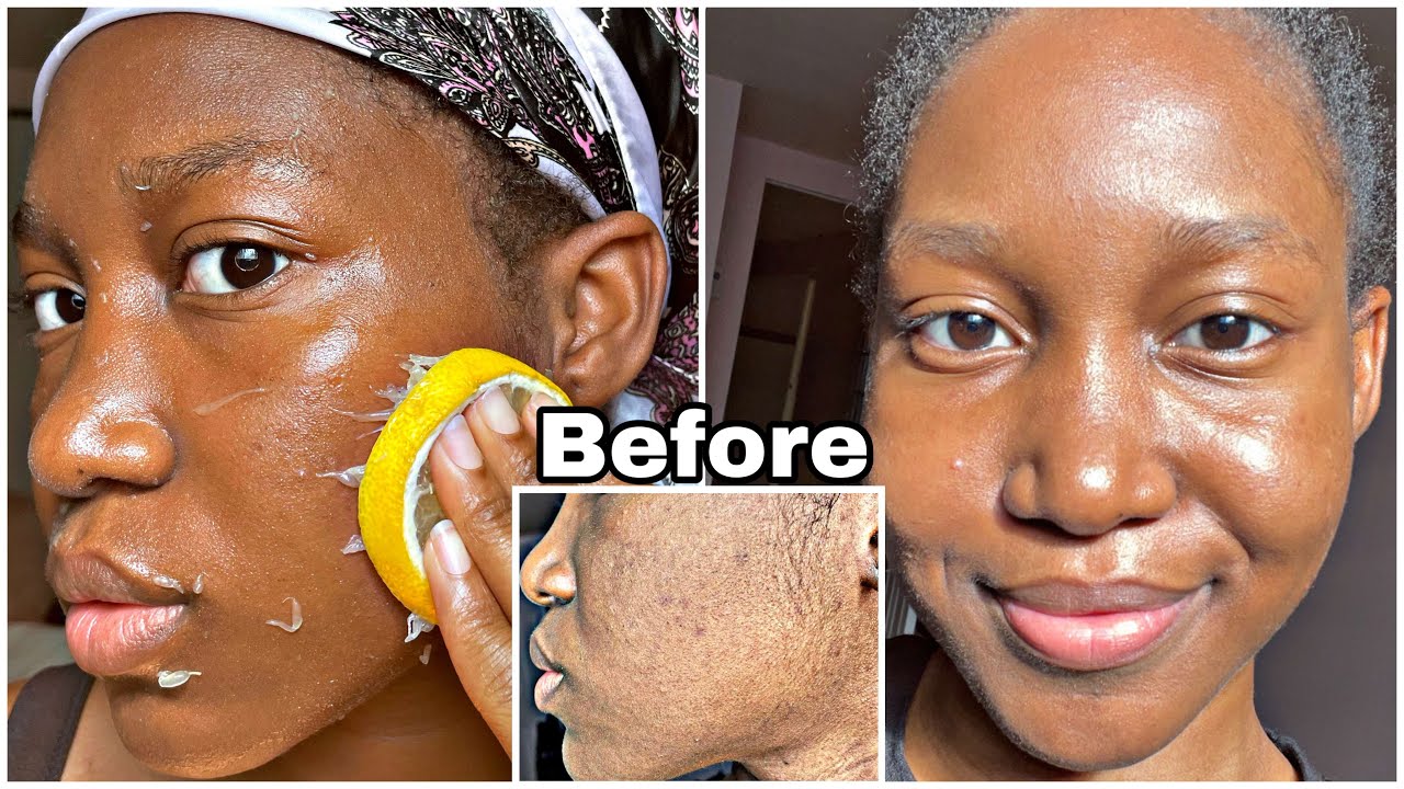 One Week of LEMON on my Face Gave me a *GLASS* Skin and Lightened my Darkspots & Acne Scars 🍋