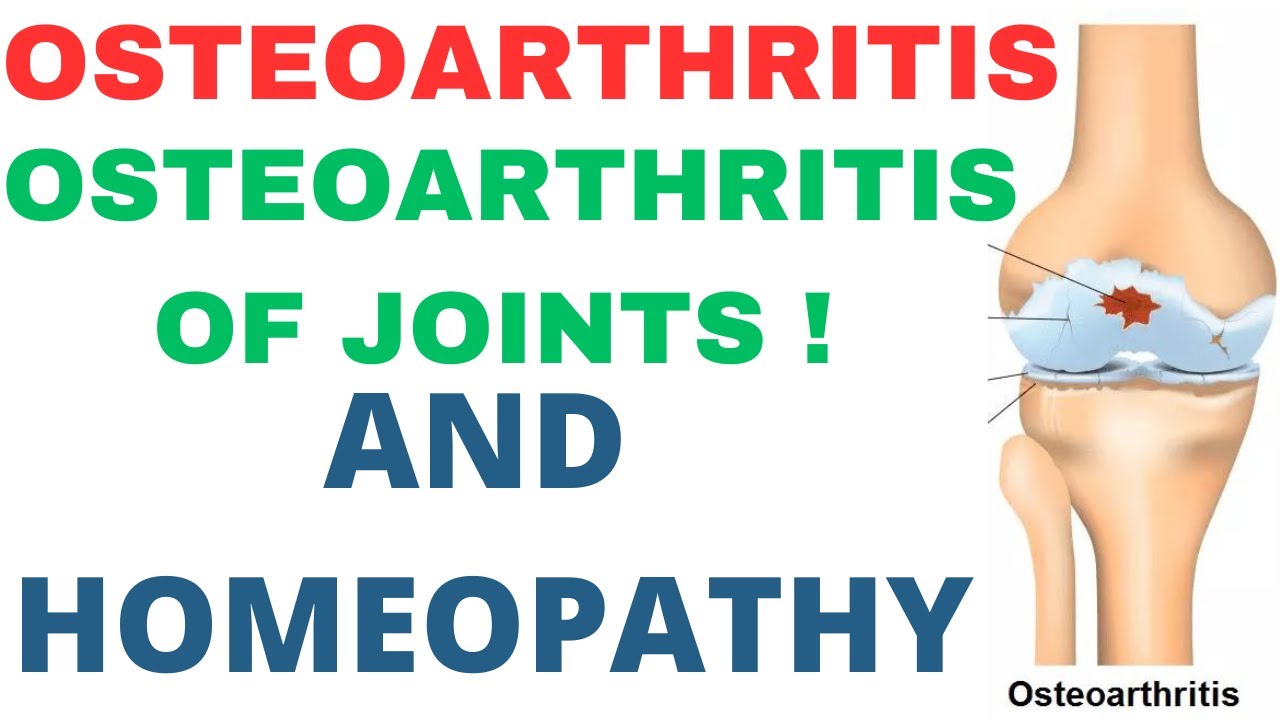 OSTEOARTHRITIS||BEST HOMEOPATHIC MEDICINE FOR OSTEOARTHRITIS|HOMEOPATHIC MEDICINE FOR OSTEOARTHRITIS