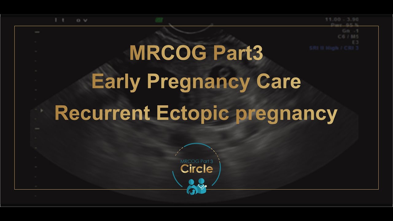 MRCOG Part 3 - Ectopic pregnancy