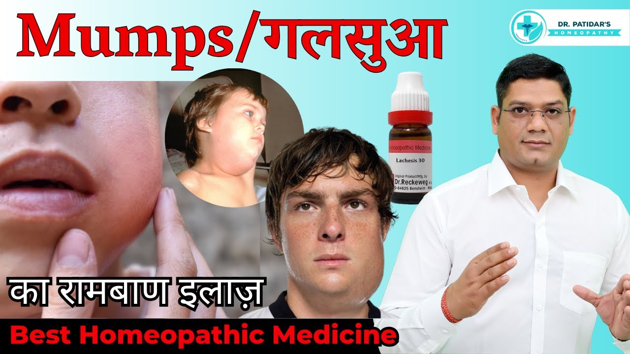 Best Homeopathic Medicine for Mumps in Children & Adults | Galsua Treatment by Dr Sunil Patidar