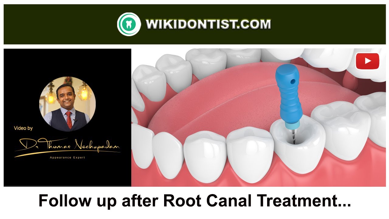 Follow up after Root Canal Treatment... Video by Dr.Thomas Nechupadam