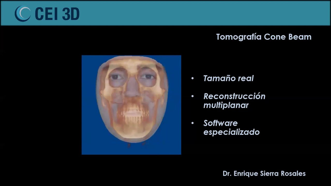 Webinar Evaluación de terceros molares con Tomografía Cone Beam