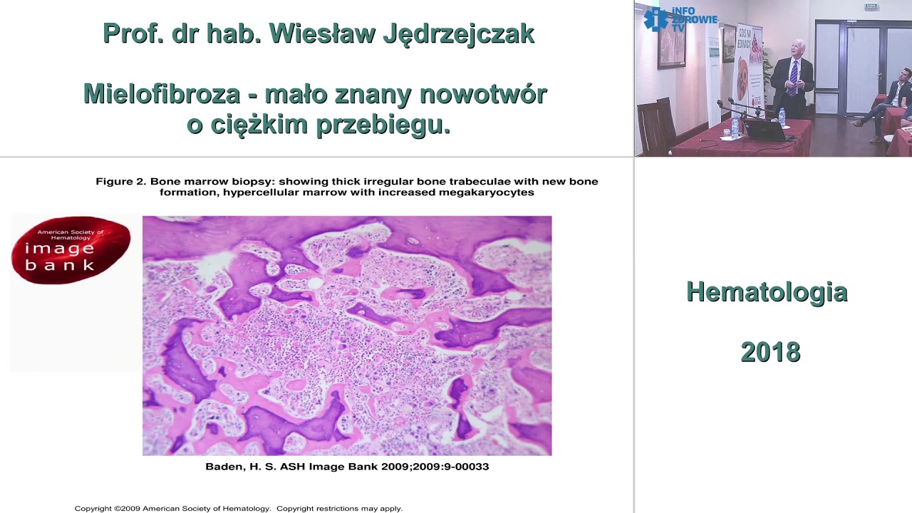 Mielofibroza mało znany nowotw&oacute;r o ciężkim przebiegu