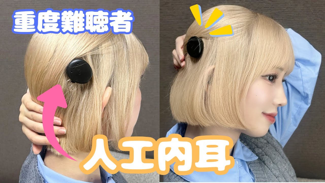 【重度難聴】人工内耳って何？全身麻酔の手術の話など詳しく紹介！