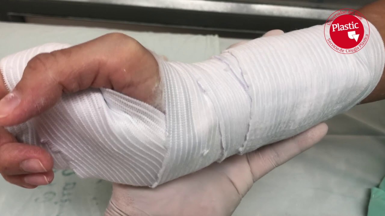 PLASTICUV - inmovilización de mano - Dr James Zapata