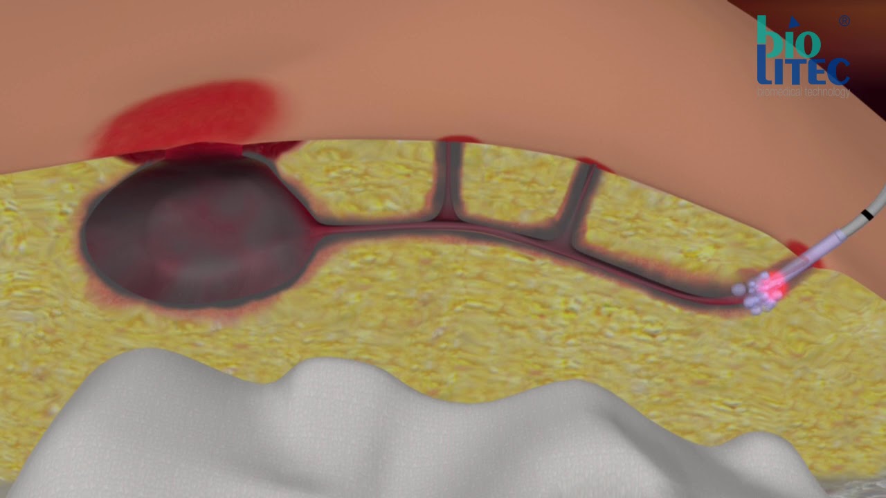 SiLaC&reg; for Sinus Pilonidalis by biolitec&reg;