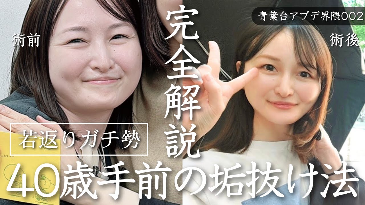 【ダウンタイム記録】フェイスラインが弛んできたので輪郭形成を決意。アラフォーのダウンタイムについて嘘なしのリアル解説！糸リフト+脂肪注入+脂肪吸引で劇的ビフォーアフターに驚き!