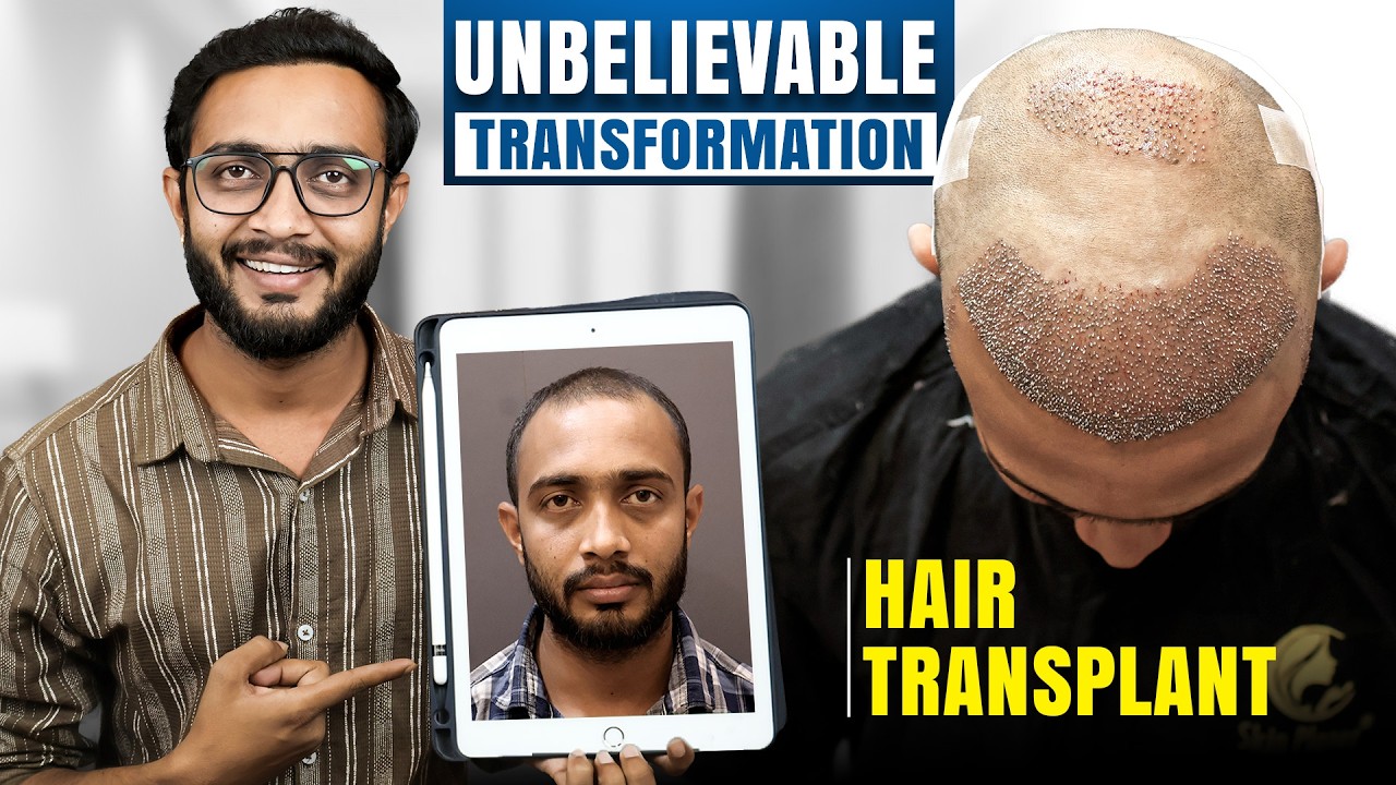 3500 Grafts Changed His Look | Grade 4 Hair Transplant | Nagpur