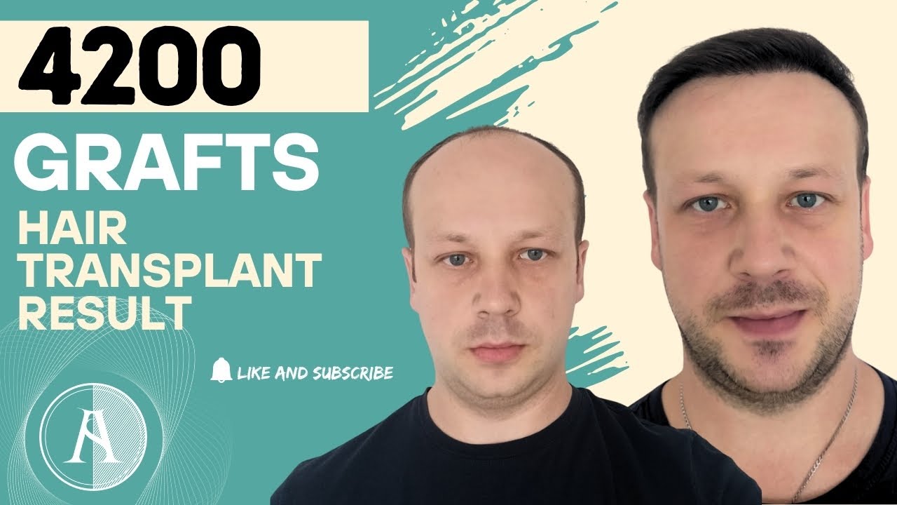 Wide Bald Area? See How We Closed 80% in the First Session!  | 4200 Grafts ≈ 8400 Hairs!