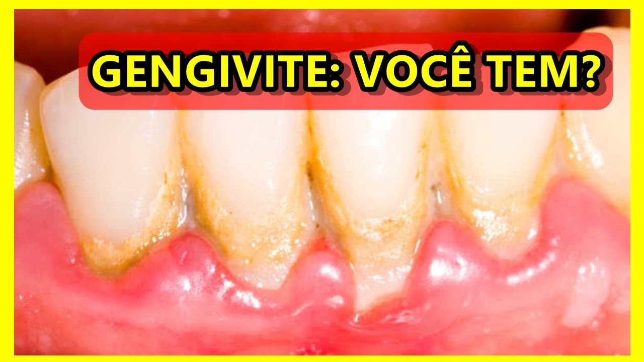 Gengivite - o que causa, sintomas e tratamento.
