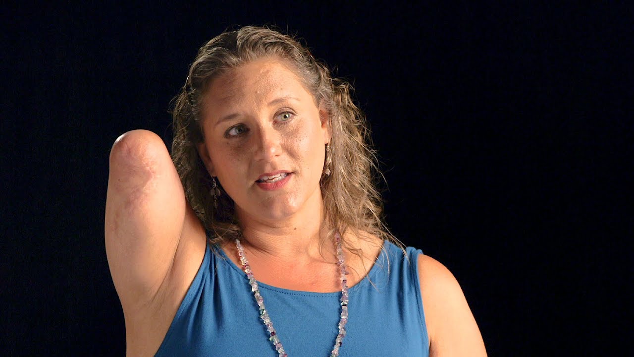 Hear This Woman's Harrowing Tale Of Losing Her Arm To A Gator Attack