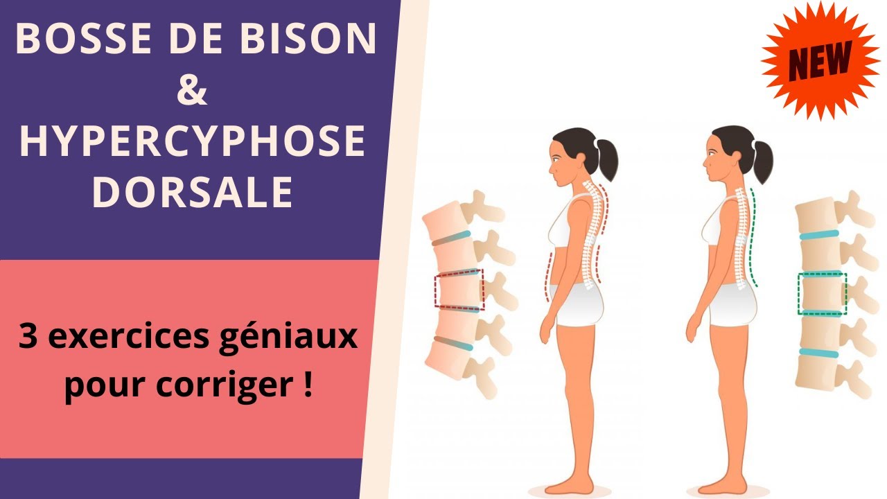 3 exercices (géniaux) pour réduire la BOSSE DE BISON !👍