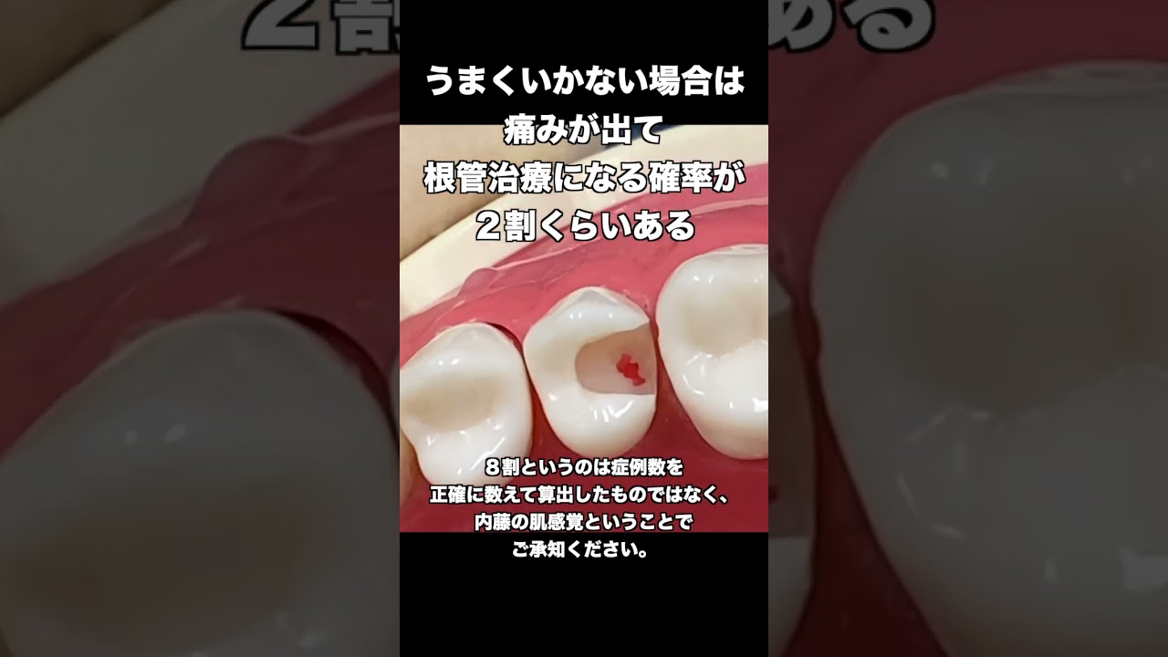 【戸塚駅前内藤歯科】歯髄を残す治療　生きている神経を残すMTA  #shorts #虫歯治療