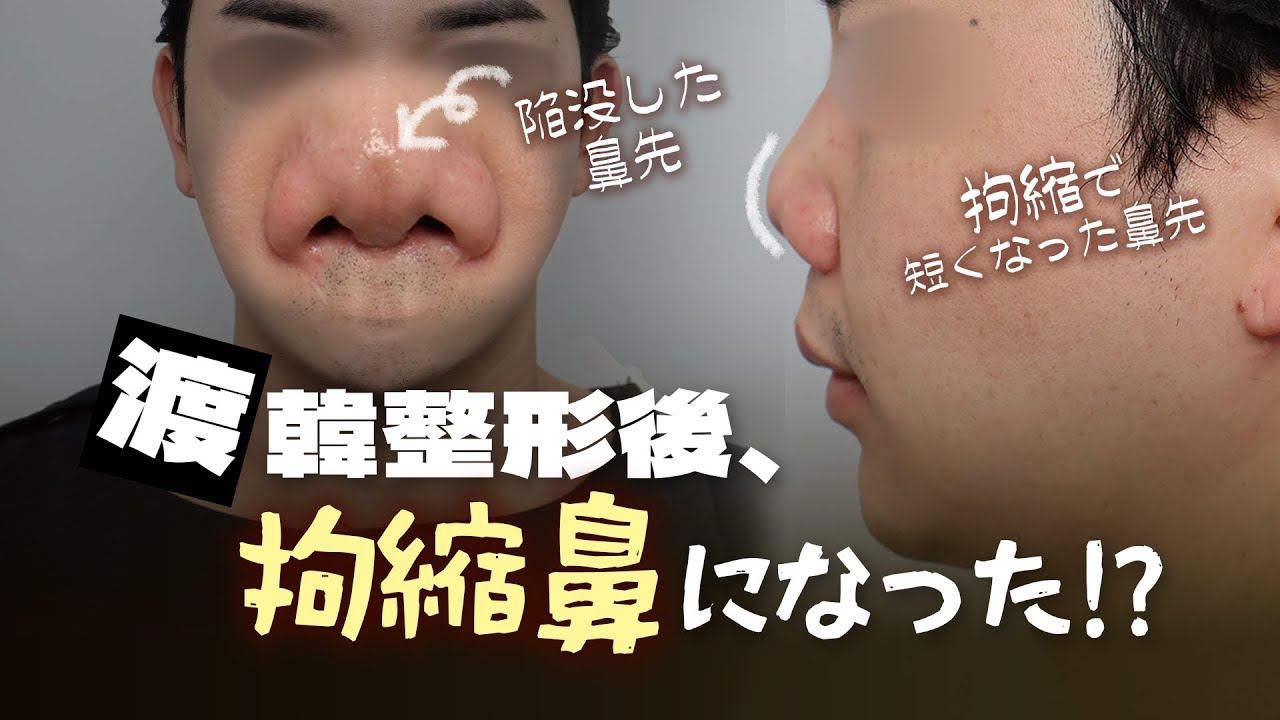 【高難易度】韓国で鼻整形後すぐ拘縮鼻に…再建手術もすぐできないって本当？